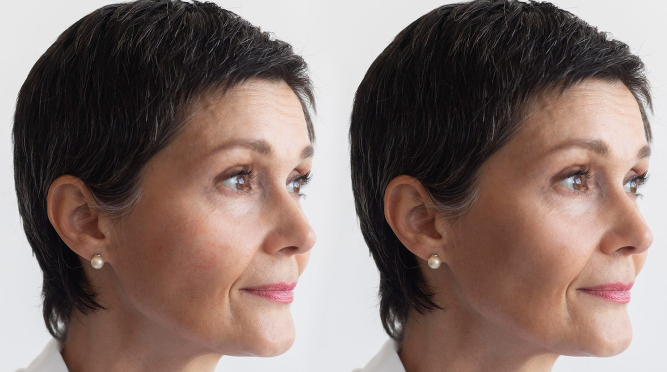 Vasculaser Láser Facial y Corporal