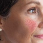 Mujer madura con ara´ña facial