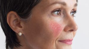 Mujer madura con ara´ña facial