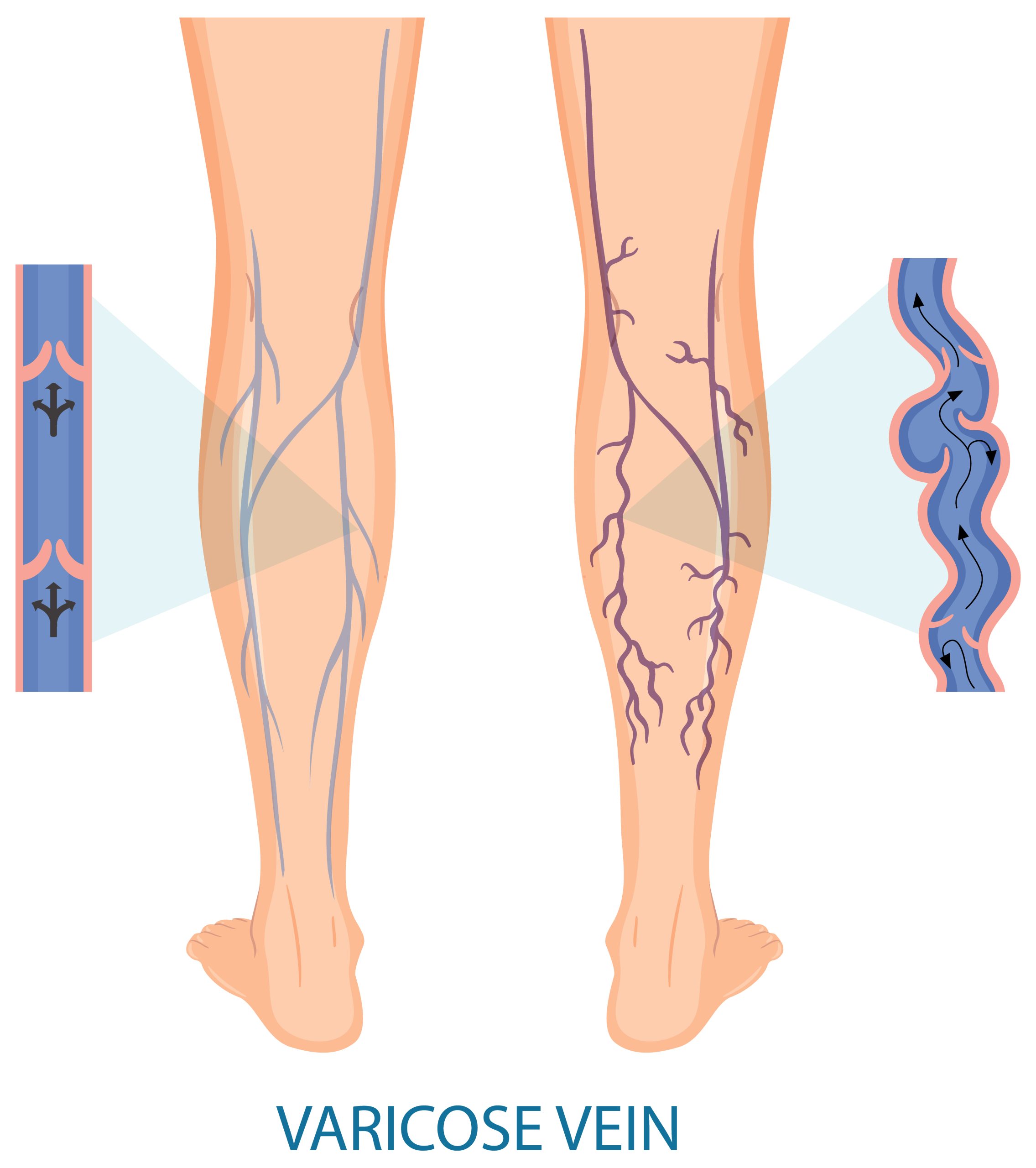Tratamiento de varices y arañas vasculares en Clínica Sinclair